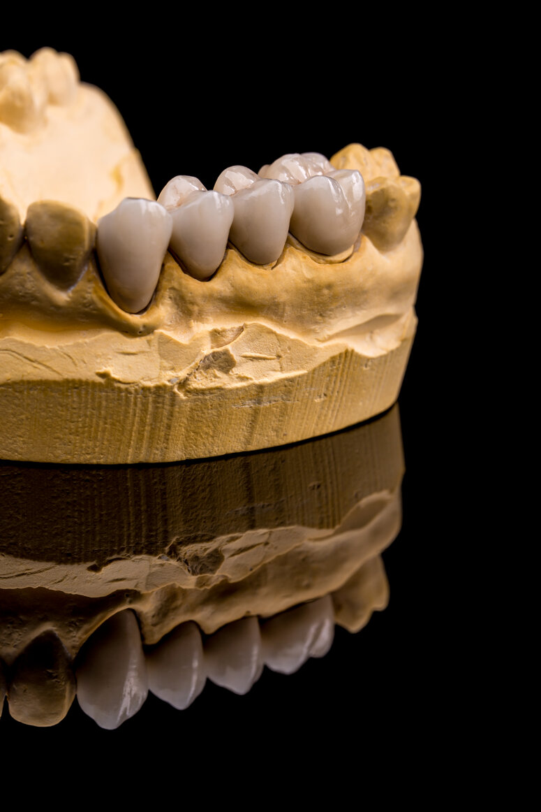 Dental Crowns Cambridge