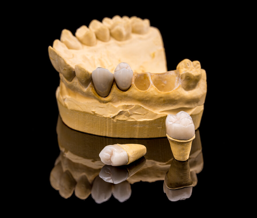 Dental Crowns Cambridge