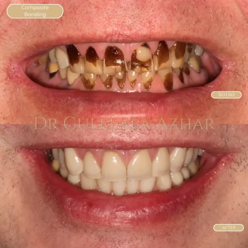Composite Bonding